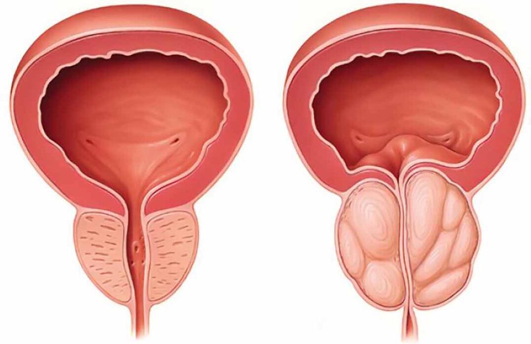 Нормальная простата и воспаление простаты (хронический простатит)