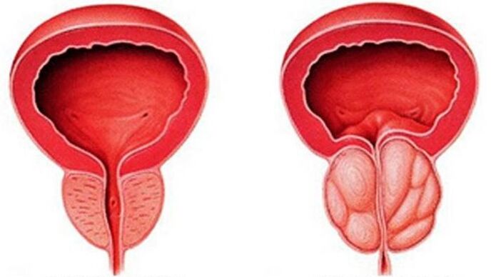 Здоровая и воспаленная простата с простатитом